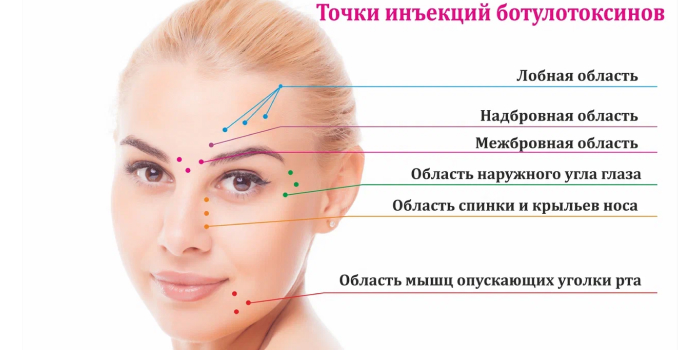 Точки инъекций ботулотоксина