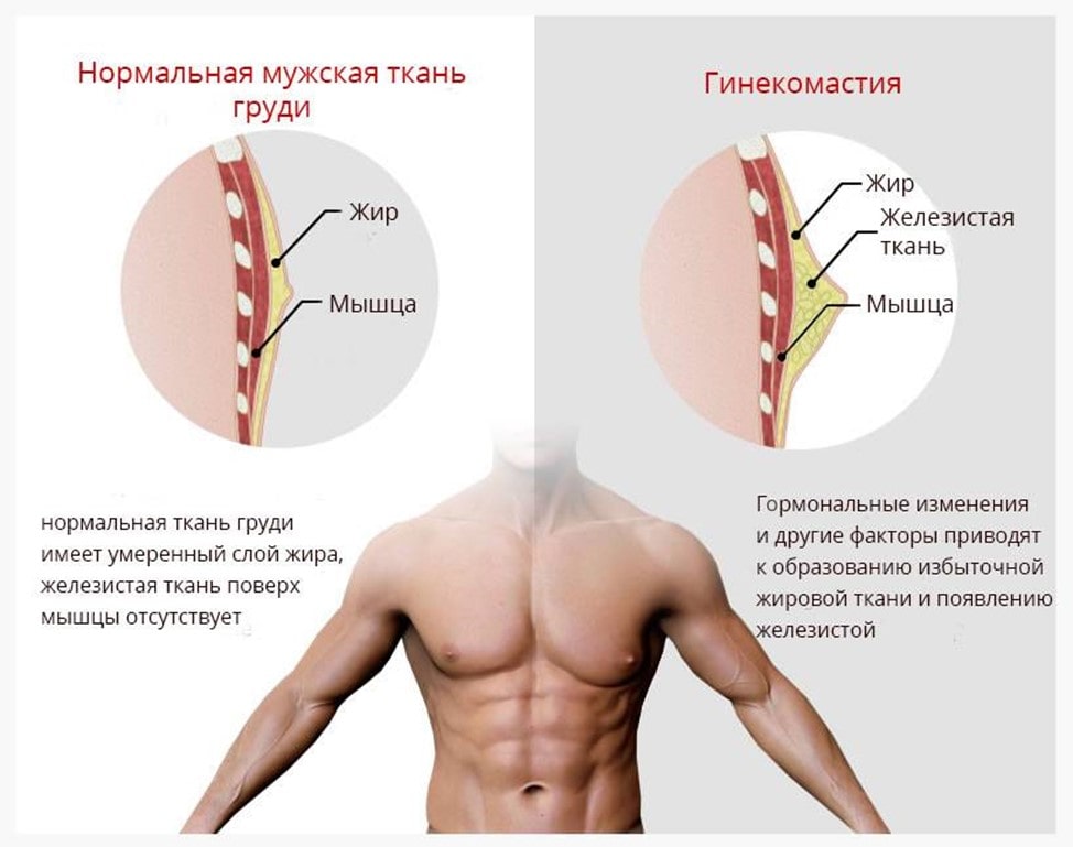 Что такое киста молочной железы — причины возникновения, симптомы, лечение