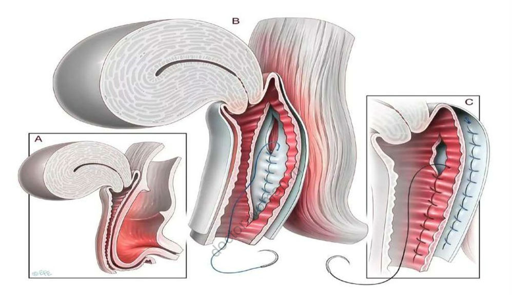 Radiological detection of the inserted drug containers into the body’s cavities of the “drug mules”