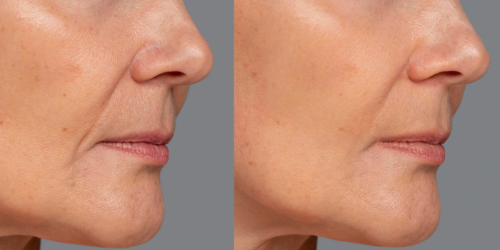 Биоревитализация лица