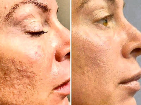 Результат до и после процедуры